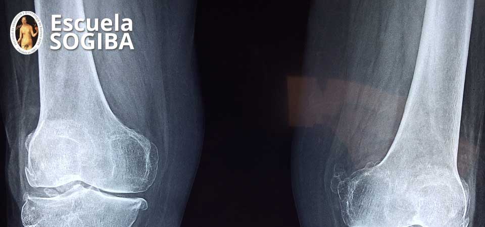 Osteoporosis: ¿qué debe conocer el tocoginecólogo en su práctica habitual?