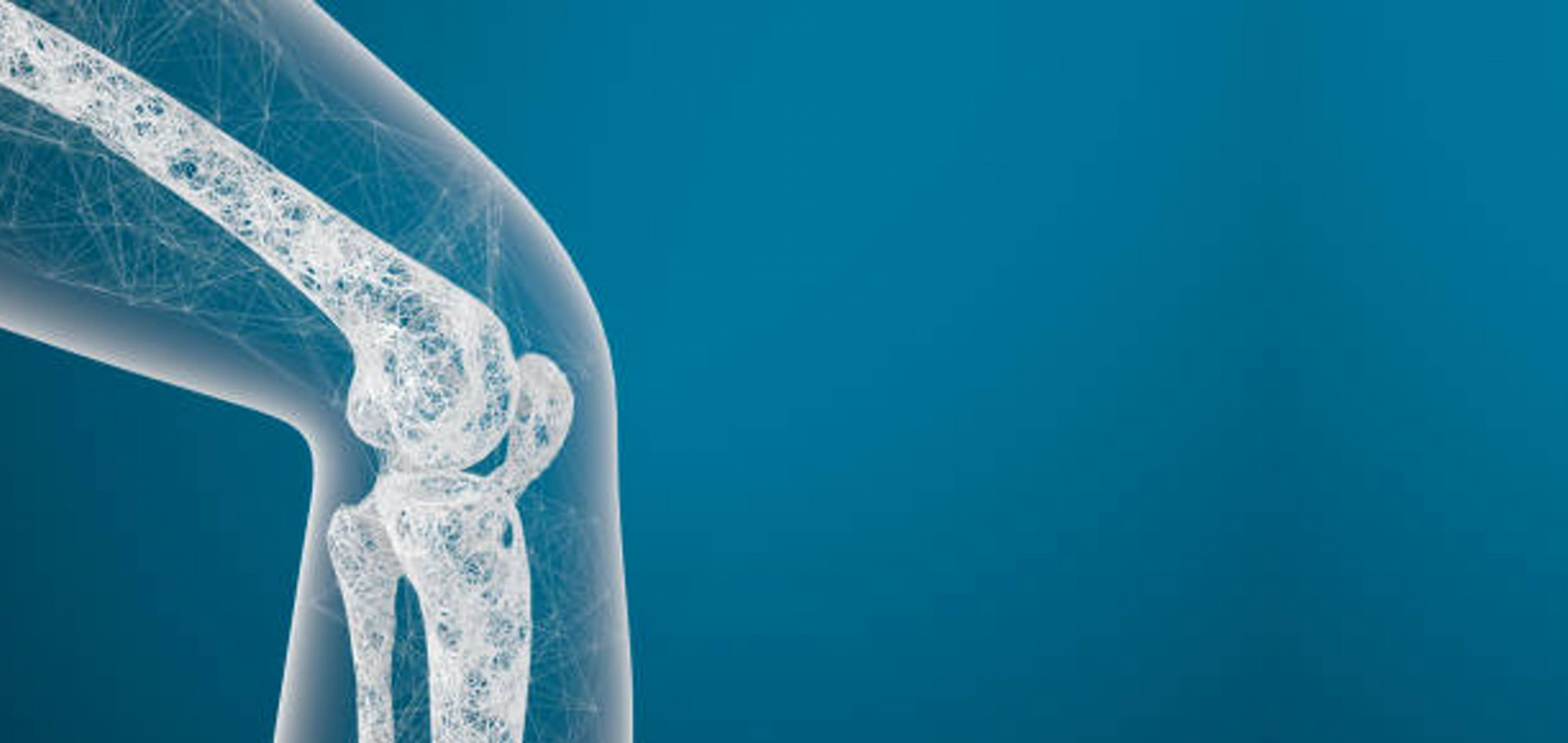 Osteoporosis: ¿qué debe conocer el tocoginecólogo en su práctica habitual?
